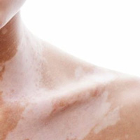 Vitiligo High Coverage Treatment